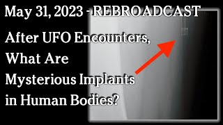 Watch May 31, 2023 - Rebroadcast - After UFO Encounters, What Are Mysterious Implants in Human Bodies?