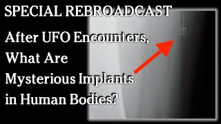 Watch Special Rebroadcast - After UFO Encounters, What Are Mysterious Implants in Human Bodies?