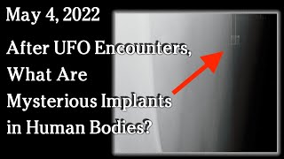 Watch May 4, 2022 - After UFO Encounters, What Are Mysterious Implants in Human Bodies?